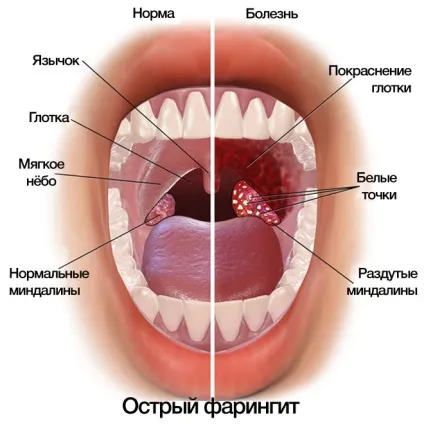 Здорові гланди як виглядає горло хворе і здорове