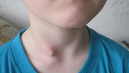 Жировик (ліпома) на шиї лікування, видалення підшкірного жировика на шиї ззаду (ліпома) Жировик (ліпома) на шиї лікування, видалення підшкірного жировика на шиї ззаду