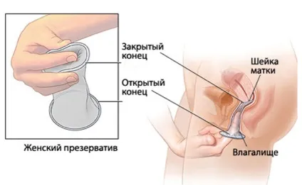 Жіночий презерватив як метод контрацепції що потрібно знати (презерватив) Жіночий презерватив як метод контрацепції що потрібно знати