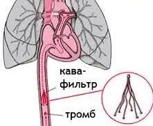 Пологи при варикозі небезпека, особливості ведення (небезпека) Пологи при варикозі небезпека, особливості ведення