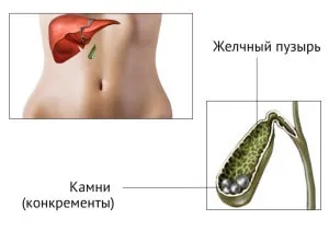 Результативні способи лікування ЖКХ без операції (жовчному міхурі метод) Результативні способи лікування ЖКХ без операції