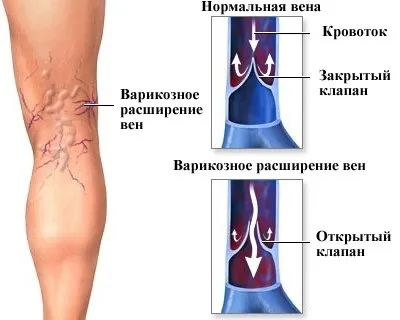 Пологи при варикозі небезпека, особливості ведення (небезпека) Пологи при варикозі небезпека, особливості ведення