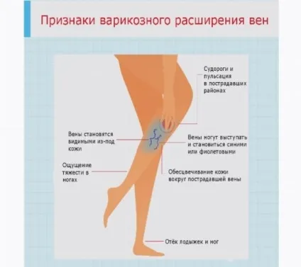 Пологи при варикозі небезпека, особливості ведення (ведення) Пологи при варикозі небезпека, особливості ведення