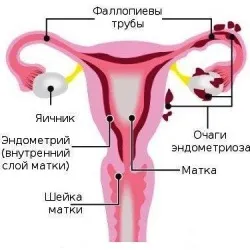 Аденоміоз матки лікування, інтимна медицина від (лікування) Аденоміоз матки лікування, інтимна медицина від