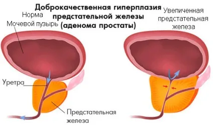 Аденома простати лікування без операції народні засоби, хімічні препарати (аденома) Аденома простати лікування без операції народні засоби, хімічні препарати