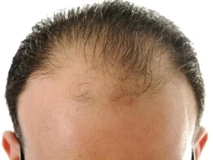 Алопеція види і їх докладний опис (захворювання Найчастіше) Алопеція види і їх докладний опис
