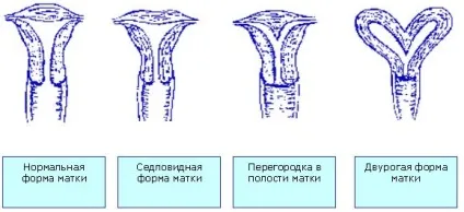 Аномалії розвитку матки - діагностика, лікування та профілактика (розвитку) Аномалії розвитку матки - діагностика, лікування та профілактика
