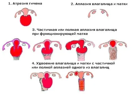 Аномалії розвитку матки - діагностика, лікування та профілактика (діагностика) Аномалії розвитку матки - діагностика, лікування та профілактика