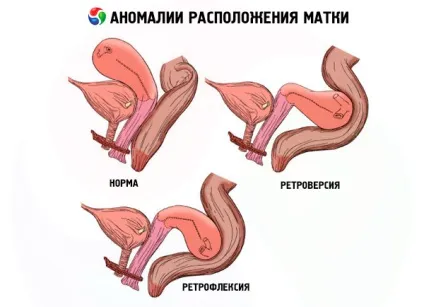 Аномалії розташування матки причини, симптоми, діагностика, лікування, компетентно про здоров'я на ilive (причини) Аномалії розташування матки причини, симптоми, діагностика, лікування, компетентно про здоров'я на ilive