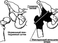 Артродез суглобів види, показання та протипоказання, проведення операції та реабілітація, (проведення) Артродез суглобів види, показання та протипоказання, проведення операції та реабілітація,