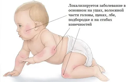 Атопічний дерматит у дітей лікування, дієта і прикорм (дерматит) Атопічний дерматит у дітей лікування, дієта і прикорм