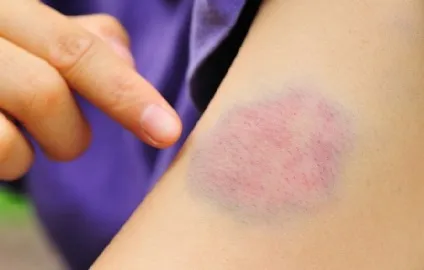 Без причини з'являються синці самі по собі на шкірі, просто так, чому (причини) Без причини з'являються синці самі по собі на шкірі, просто так, чому