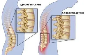 хвороби суглобів