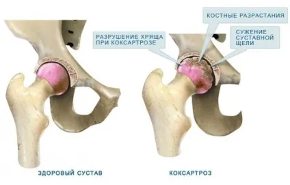 хвороби суглобів