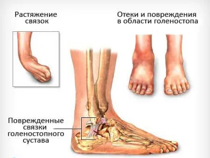 Біль в щиколотці - причини появи симптому, способи лікування (щиколотці) Біль в щиколотці - причини появи симптому, способи лікування