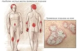Чим відрізняється псоріаз від екземи (риси екземи псоріазу) Чим відрізняється псоріаз від екземи