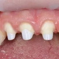 Що робити якщо мертвий зуб зламався під корінь, perfectsmile (Відновлення кукси зуба пломбою) Що робити якщо мертвий зуб зламався під корінь, perfectsmile