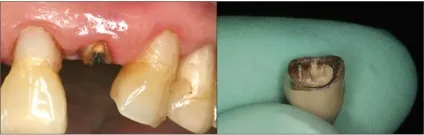 Що робити якщо мертвий зуб зламався під корінь, perfectsmile (штифти) Що робити якщо мертвий зуб зламався під корінь, perfectsmile