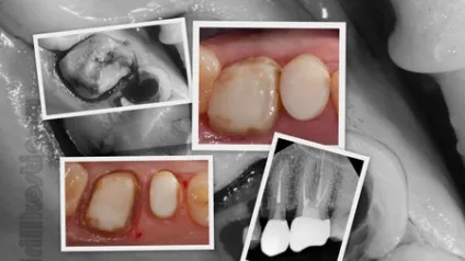Що робити якщо мертвий зуб зламався під корінь, perfectsmile (Відновлення кукси зуба) Що робити якщо мертвий зуб зламався під корінь, perfectsmile