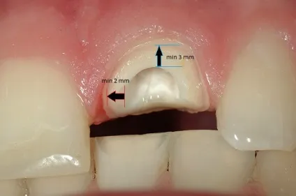 Що робити якщо мертвий зуб зламався під корінь, perfectsmile (Відновлення кукси зуба пломбою) Що робити якщо мертвий зуб зламався під корінь, perfectsmile