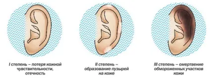 Що робити при обмороженні вуха перша допомога, лікування, ознаки, симптоми (відморожені вуха у людини) Що робити при обмороженні вуха перша допомога, лікування, ознаки, симптоми