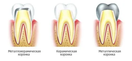 Що краще коронка або пломба або штифт види пломб, коронок, особливості (штифт) Що краще коронка або пломба або штифт види пломб, коронок, особливості