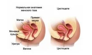 Цистоцеле - операція і лікування цистоцеле (операція) Цистоцеле - операція і лікування цистоцеле