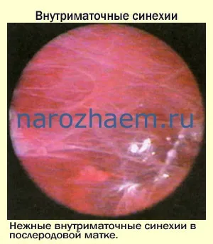 Cінехіі в порожнині матки-небезпечно це, проблеми чоловічого і жіночого безпліддя та методи їх вирішення (cінехіі в порожнині матки симптоми діагностика лікування) Cінехіі в порожнині матки-небезпечно це, проблеми чоловічого і жіночого безпліддя та методи їх вирішення