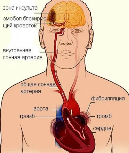 Cтепени тяжкості ішемічного інсульту (течії ішемічного інсульту) Cтепени тяжкості ішемічного інсульту