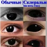 Деструкція склоподібного тіла ока ніж небезпечно, знайдено рішення, лікування народними засобами, як (деструкція склоподібного тіла ока ніж небезпечно) Деструкція склоподібного тіла ока ніж небезпечно, знайдено рішення, лікування народними засобами, як