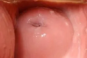 Дисплазія шийки матки (cin, lsil, hsil)