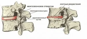 Діагноз остеохондроз поперекового відділу хребта патогенез (відділу) Діагноз остеохондроз поперекового відділу хребта патогенез