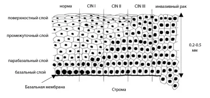 Дисплазія шийки матки (cin, lsil, hsil)
