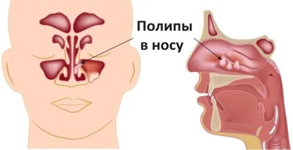 Діагностика, причини і лікування поліпозу (поліпозний синусит лікування) Діагностика, причини і лікування поліпозу