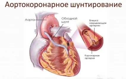 Дієта після аортокоронарного шунтування - що можна, а що не можна (дієта) Дієта після аортокоронарного шунтування - що можна, а що не можна