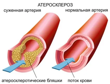 Дієта після аортокоронарного шунтування - що можна, а що не можна (після) Дієта після аортокоронарного шунтування - що можна, а що не можна