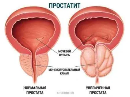 Ефективне лікування простатиту народними засобами (ефективне лікування простатиту народними засобами в домашніх умовах) Ефективне лікування простатиту народними засобами