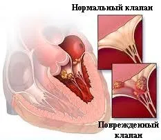 Ендокардит причини, симптоми, діагностика та лікування інфекційного ендокардиту - medglobus медглобус