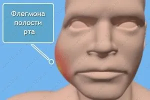 Флегмона щелепно-лицевої ділянки (шиї, дна порожнини рота, щелеп, мови) симптоми і лікування (щелепно-лицевої) Флегмона щелепно-лицевої ділянки (шиї, дна порожнини рота, щелеп, мови) симптоми і лікування