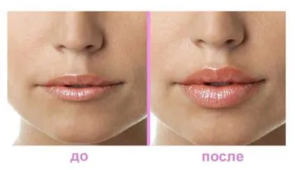 Філлери в губи відгуки, фото, техніка введення (відгуки) Філлери в губи відгуки, фото, техніка введення