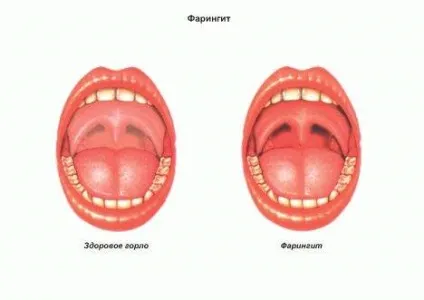 Фарингіт у дітей, симптоми і лікування комаровский