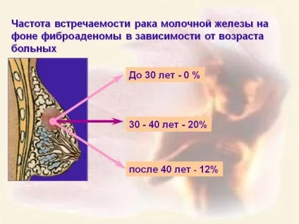 Фіброаденома молочної залози що це таке, симптоми, причини, фото, лікування (молочної) Фіброаденома молочної залози що це таке, симптоми, причини, фото, лікування