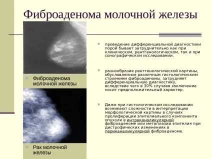 Фіброаденома молочної залози що це таке, симптоми, причини, фото, лікування (фіброаденома) Фіброаденома молочної залози що це таке, симптоми, причини, фото, лікування