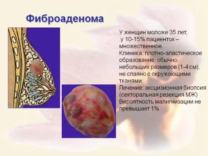 Фіброаденома молочної залози що це таке, симптоми, причини, фото, лікування (фіброаденома) Фіброаденома молочної залози що це таке, симптоми, причини, фото, лікування