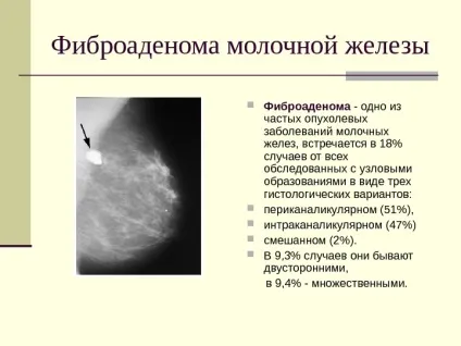 Фіброаденома молочної залози що це таке, симптоми, причини, фото, лікування (фіброаденома) Фіброаденома молочної залози що це таке, симптоми, причини, фото, лікування