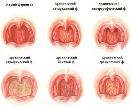 Фарингіт у дітей, симптоми і лікування комаровский