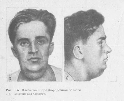 Флегмона щелепно-лицевої ділянки (шиї, дна порожнини рота, щелеп, мови) симптоми і лікування (флегмона шиї. Лікування флегмони) Флегмона щелепно-лицевої ділянки (шиї, дна порожнини рота, щелеп, мови) симптоми і лікування