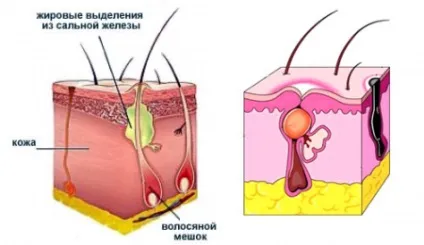 Фурункул, лікування причини виникнення чірья, стадії розвитку, ускладнення (стадії) Фурункул, лікування причини виникнення чірья, стадії розвитку, ускладнення