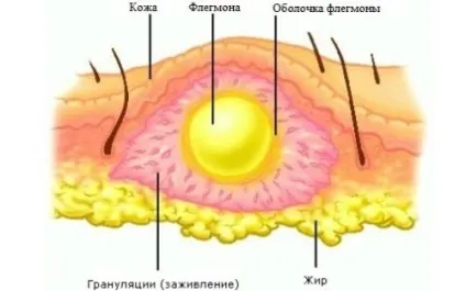 Фурункул, лікування причини виникнення чірья, стадії розвитку, ускладнення (причини) Фурункул, лікування причини виникнення чірья, стадії розвитку, ускладнення