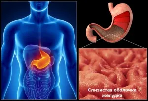 Гастрит шлунку симптоми, лікування, дієта, харчування (дієта) Гастрит шлунку симптоми, лікування, дієта, харчування